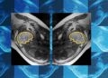 Why teaching AI about symmetry could make prenatal diagnosis more reliable | MIT News