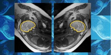 Why teaching AI about symmetry could make prenatal diagnosis more reliable | MIT News