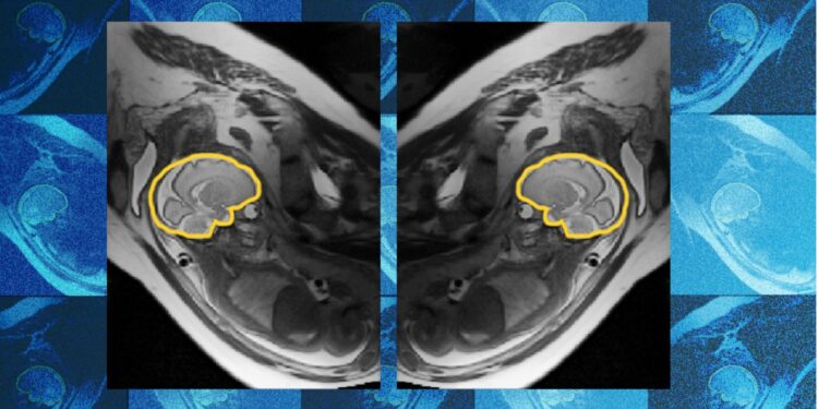 Why teaching AI about symmetry could make prenatal diagnosis more reliable | MIT News